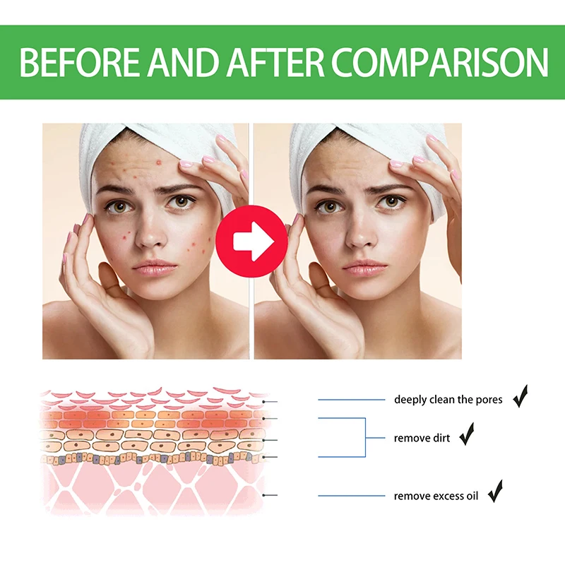 Невидимые пластыри от прыщей нос подбородка лоб щеки прыщи пятна следы консилер