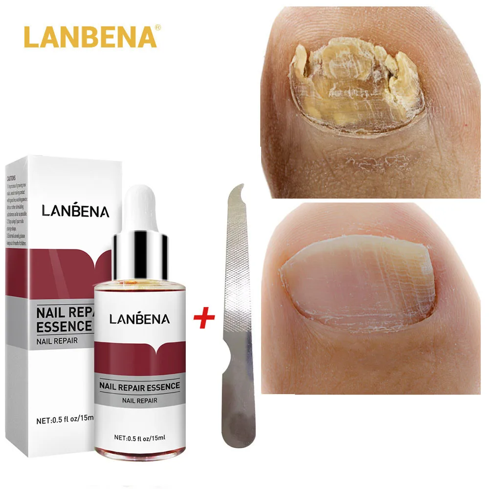 LANBENA Fungus Nail Serum Essence Anti Fungal Nail Treatment Fluid Against Onychomycosis Repairing Brighten Hand Toes Nail Care