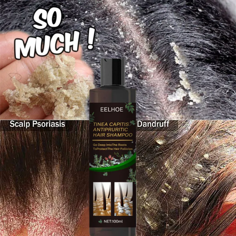 

100ml Therapeutic Shampoo Anti-Dandruff Treatment Itching Flaking Scalp Psoriasis Seborrheic Dermatitis Hair Care