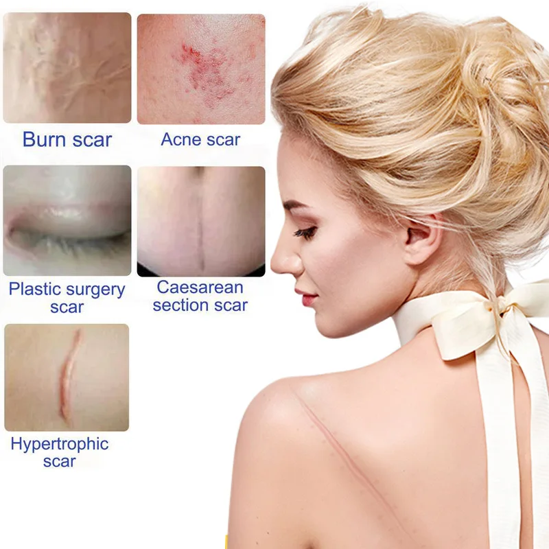 Пластыри силиконовые прозрачные для лечения рубцов 4x300 см