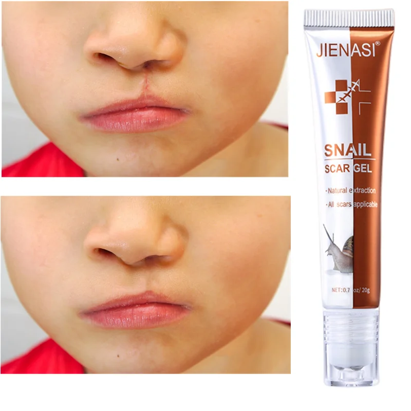 

JIENASI Scar Gel Cream Burn Surgical Scar Stretch Marks Acne Spots Removal Repair Smoothing Whitening Beauty Brighten Skin Care