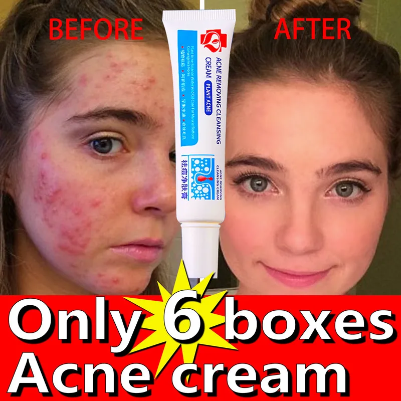 

Only 6 Pcs To Solve All Kinds of Acne and Acne Marks Face Cream Moisturizing Oil Control Get Rid of Closed Mouth Repair Skin 30g