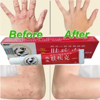 professional treatment psoriasis ointment dermatitis skin eczema blister folliculitis pruritus antibacterial cream