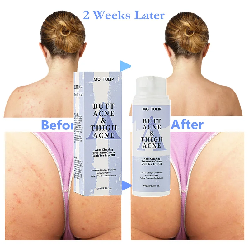 

100ml Butt Acne Clearing Spot Treatment Cream Clears Acne Pimples Zits Razor Bumps and Dark Spot for the Buttocks and Thigh Area