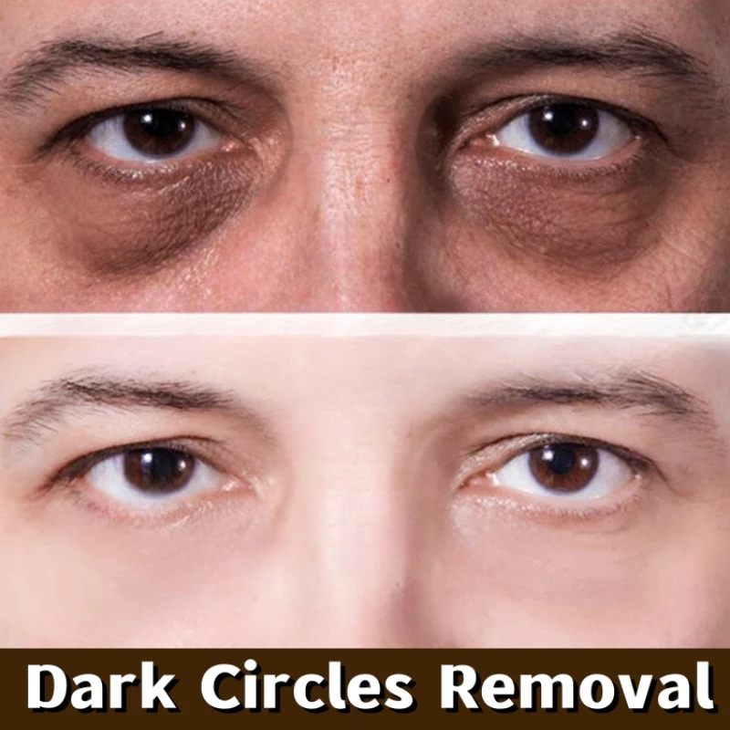 круги вокруг глаз у мужчин