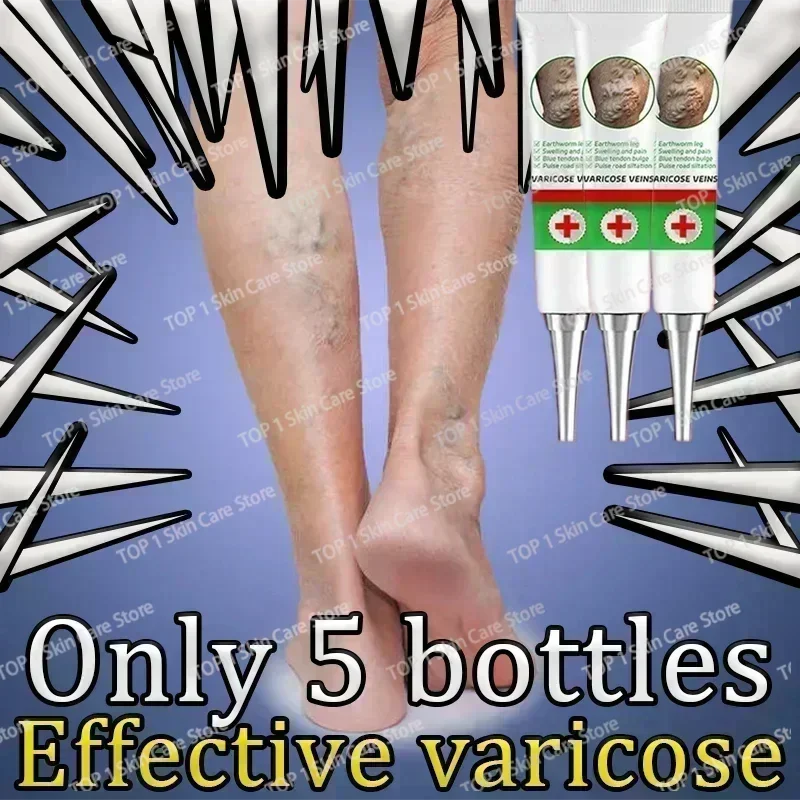 Эффективное успокаивание варикозного расширения вен. Успокаивающий васкулит