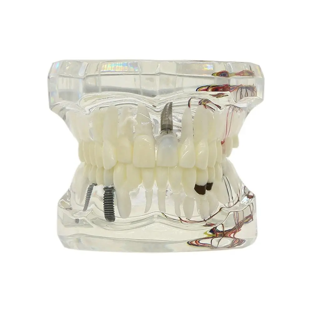 

Dental Teeth Model Implant Disease Neural Repair Pathological Model with Removable Teeth