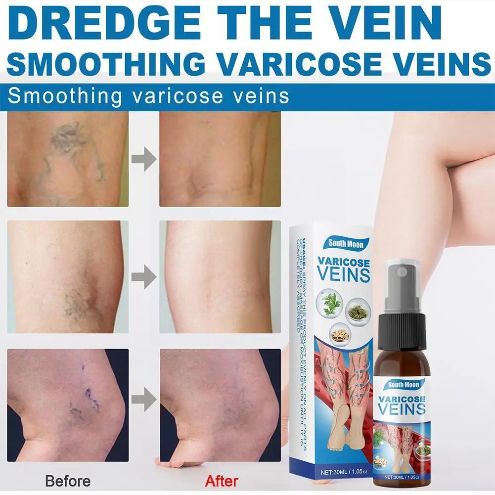 

30g Varicose Vein Soothing Spray Veins Treatment Spray Cure Bad Bilges Lumps Itching On Leg Leg Acid Solution Earthworm Nat W2R3