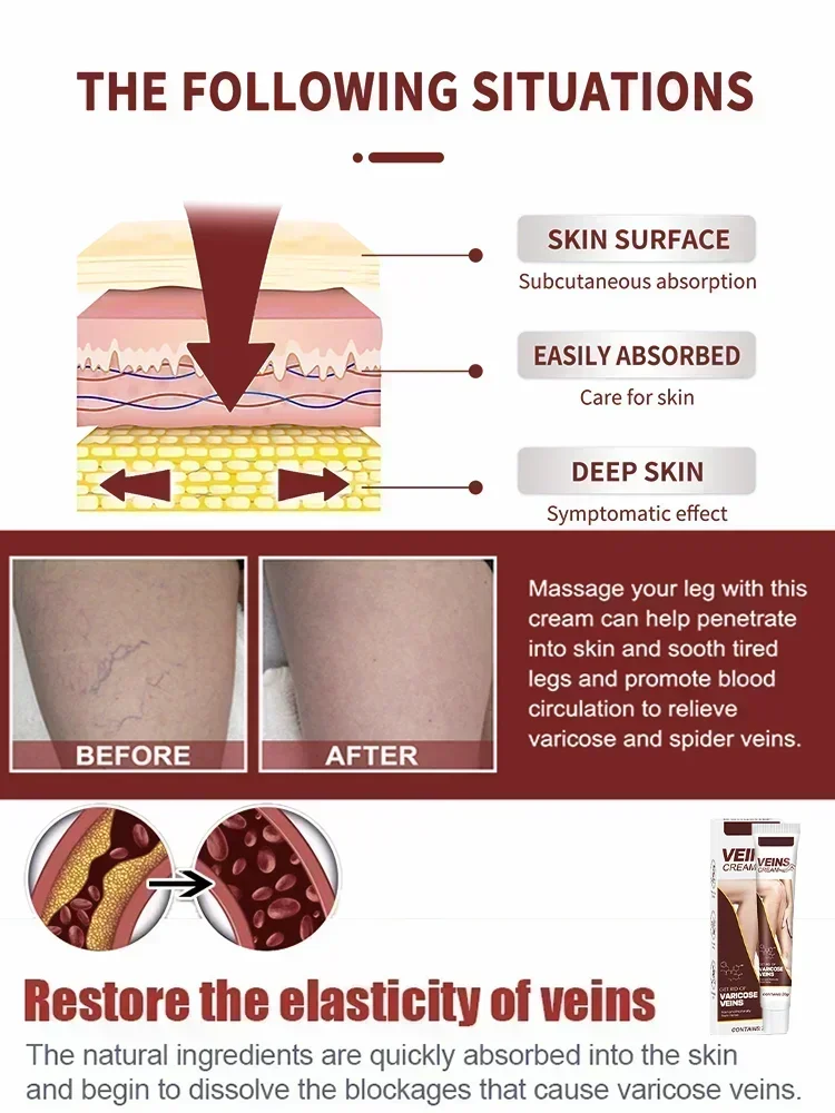 Varicose Vein Treatment Leg Health Ointment Effectively Removing Spider Veins2210