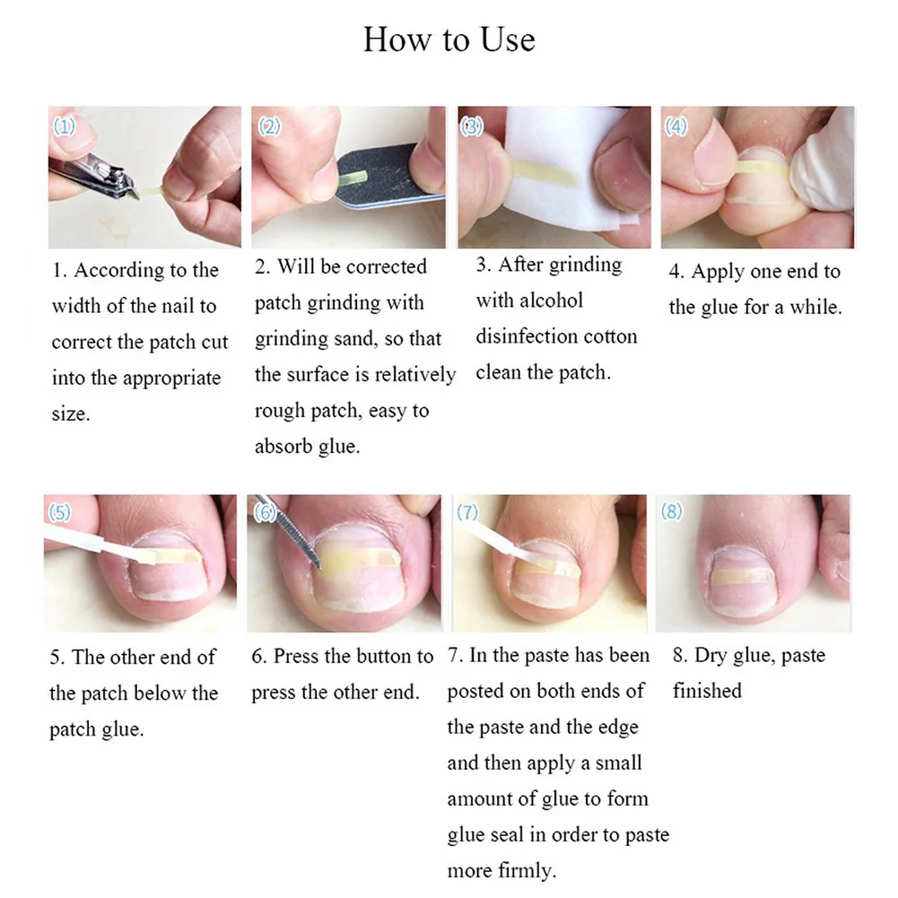 

10 шт., патчи для выпрямления вросших ног