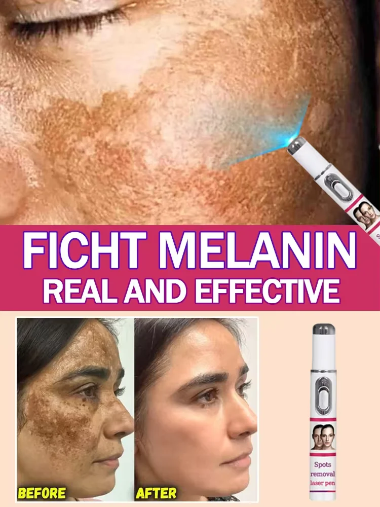 Ручка Лазерная портативная для лечения варикозного расширения вен