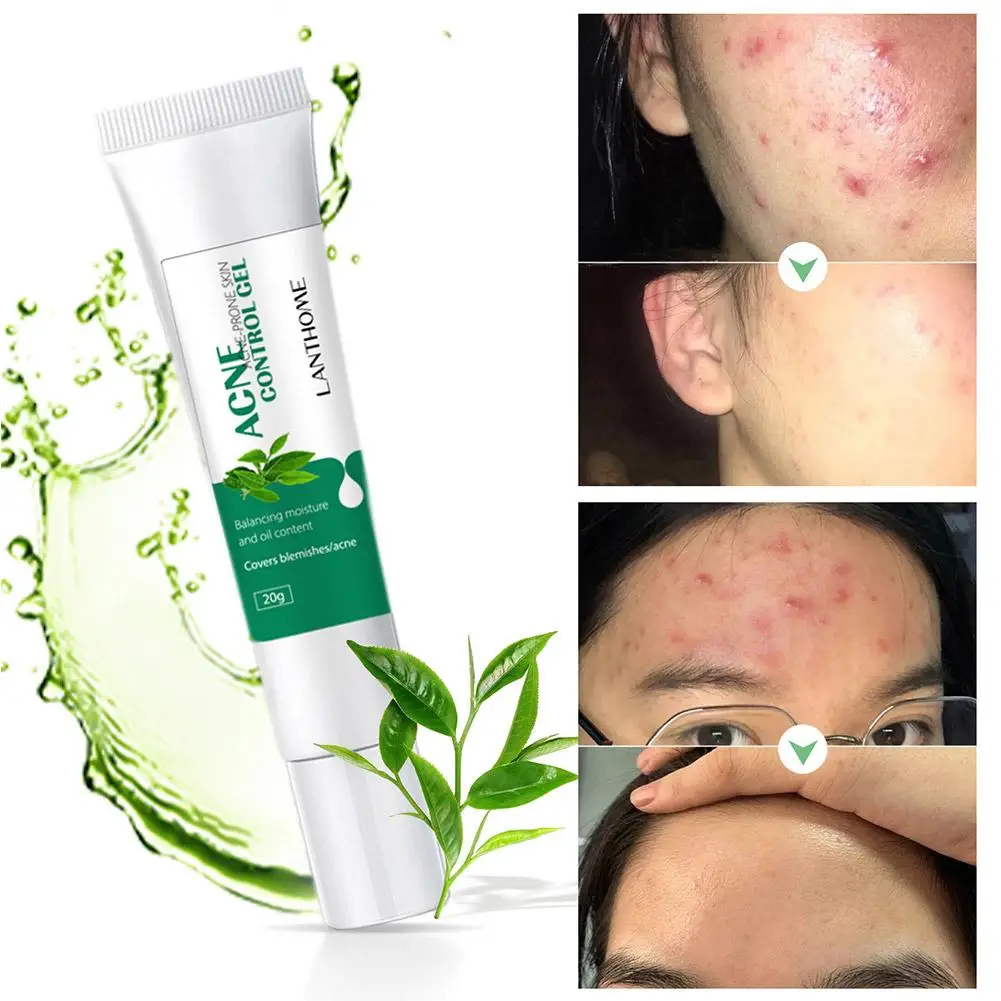 

20g Herbal Acne Cream To Remove Acne And Eliminate Oil Control Acne Acne Care Marks Anti-inflammatory Treatment Skin Effici F8F8