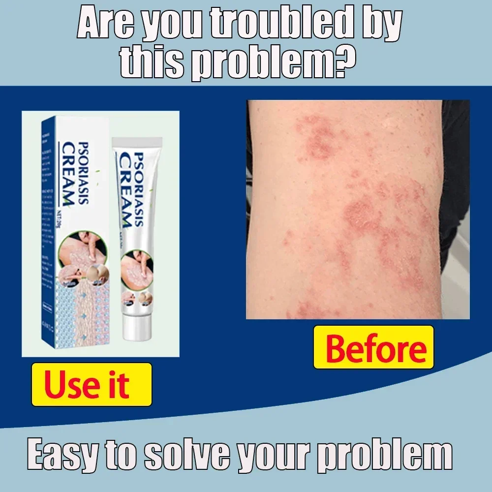 Антибактериальная мазь для лечения псориаза тела и бедра