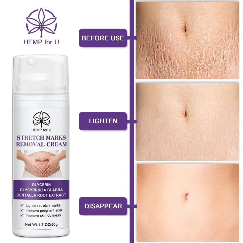 

HFU 50G Maternity Stretch Marks Removal Cream Body Buttock Breast Mark Skin Care Repair Anti-White Stretch Scar Remover Crea