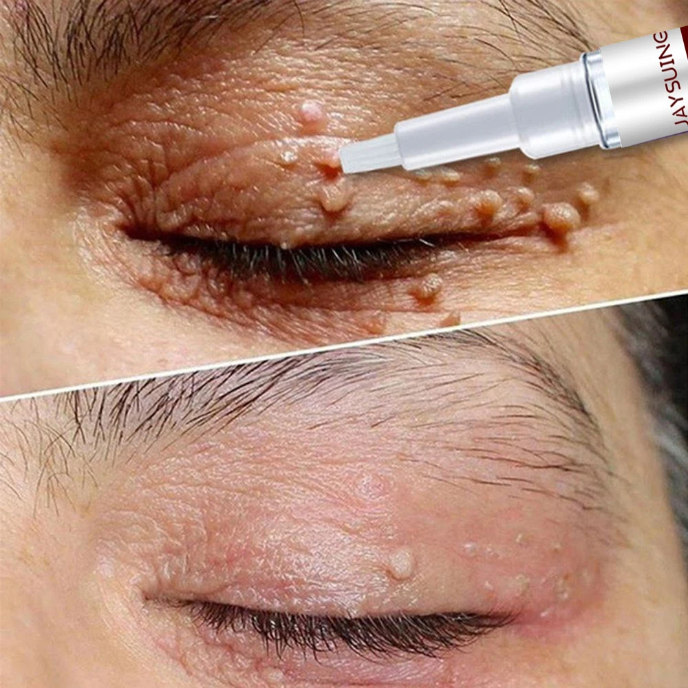 

Fast Acting Wart Removal Serum Gel Painless Skin Mole Remedy Tags Flat Genital Warts Treat Liquid Pen Black Spots Beauty Health