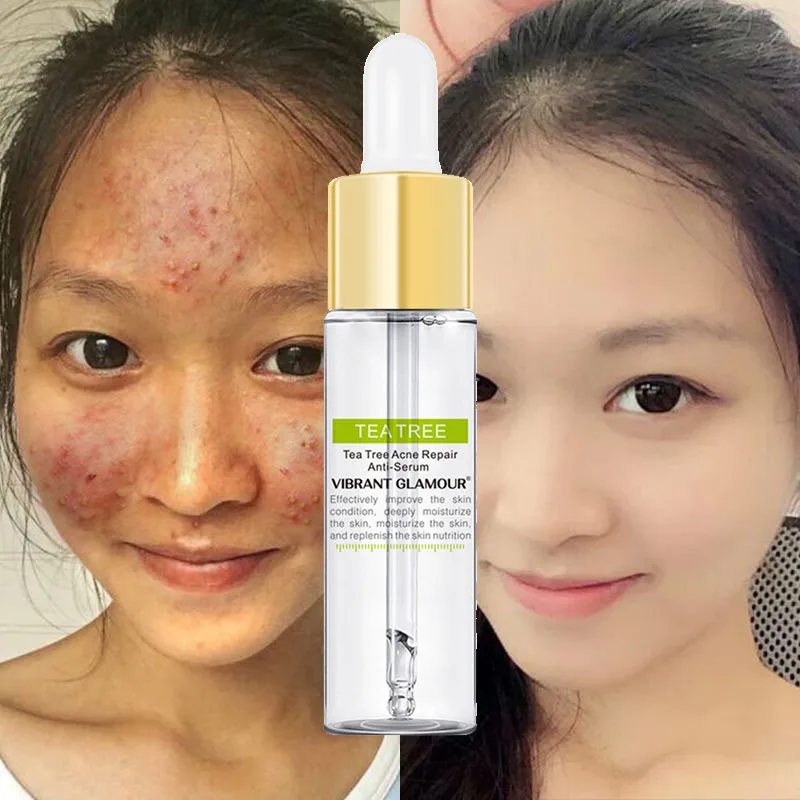 

Tea Tree Face Serum Anti-Acne Moisturizing Fades Acne Marks Shrink Pores Repair Damaged Skin Anti-Wrinkle Anti-Aging 15ml/30ml