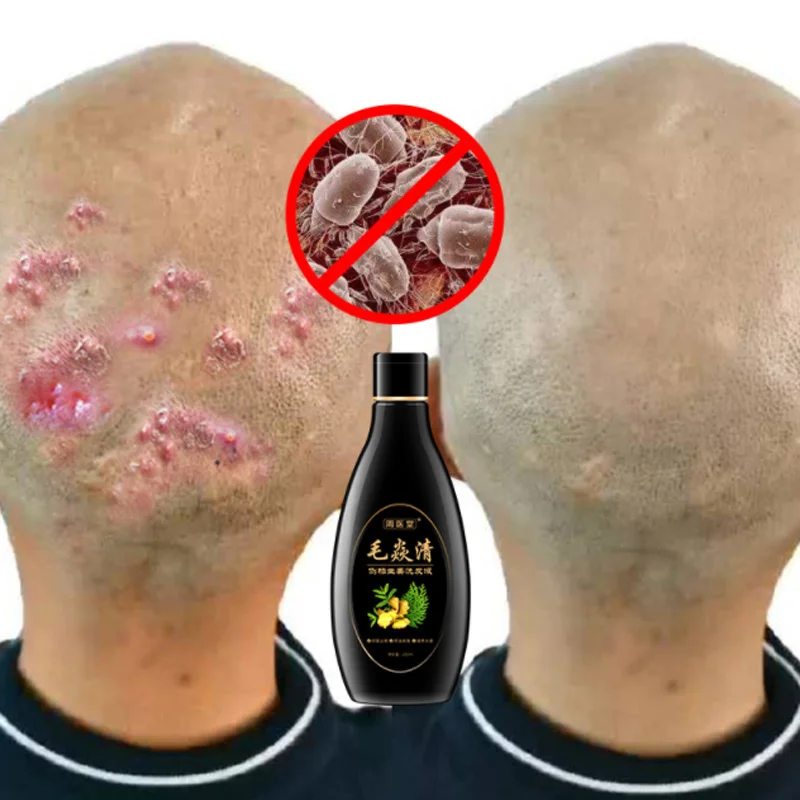 

Natural Plant Hair Psoriasis Seborrheic Treatment Dermatitis Eczema Herbal Shampoo Antibacterial, Itching, Mites, Oil Control