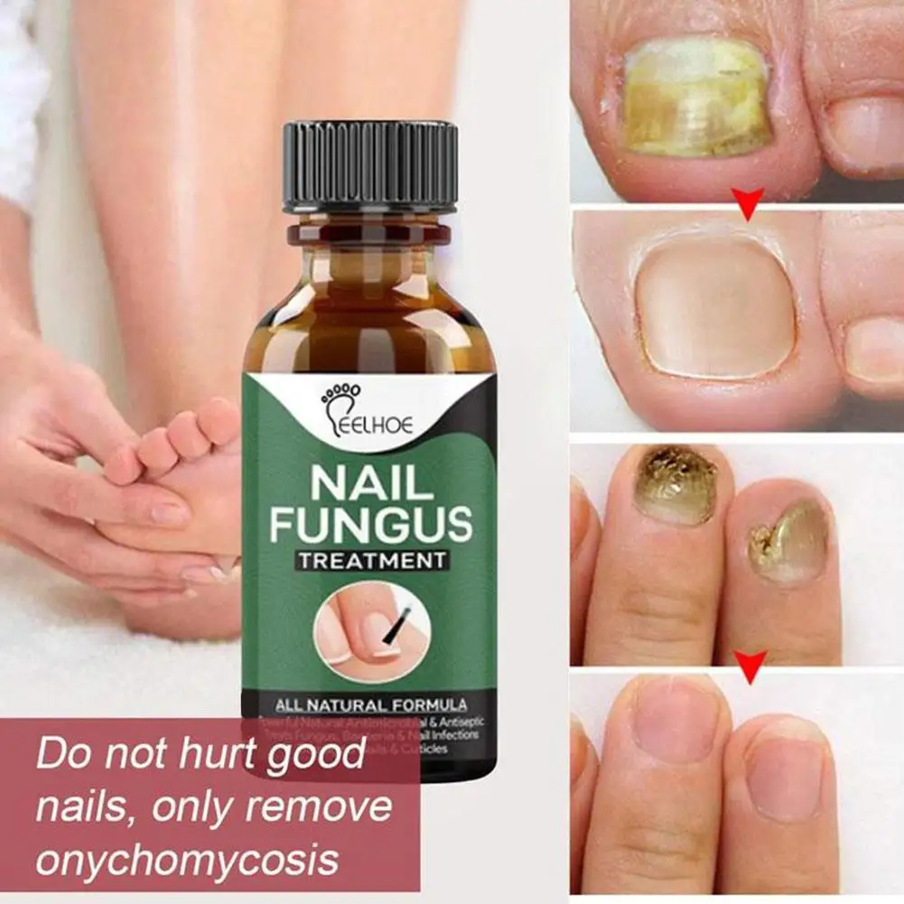 

Nail Fungal Treatment Feet Care Essence Nails Foot Paronychia Anti Infection Nail Toe Repair Fungus Oils Removal Onychomyco A8L1