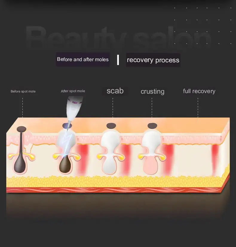 Плазменное Устройство Для Удаления Родинок Устранения Кожных Меток Лазерный