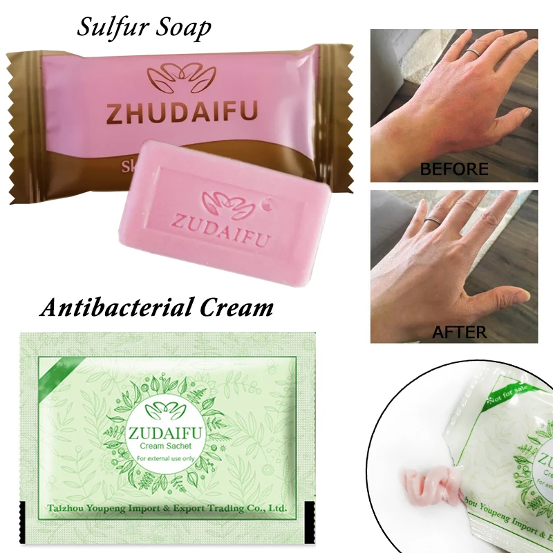 

Sdattor zudaifu Sulfur Soap add 1PC zudaifu Psoriasis Cream Dermatitis Eczematoid Eczema Ointment Treatment Skin Psoriasis