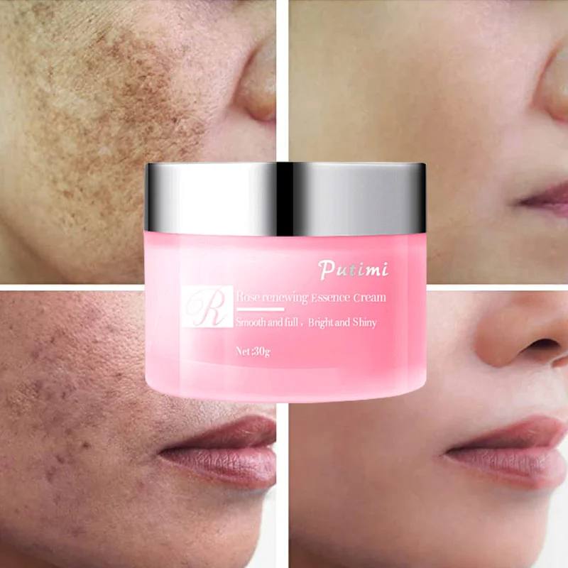 

Effective Freckle Cream Whitening Cream Remove Dark Spots Fade Acne Scars Melanin Pigmentation Melasma Anti-Aging Brighten Skin