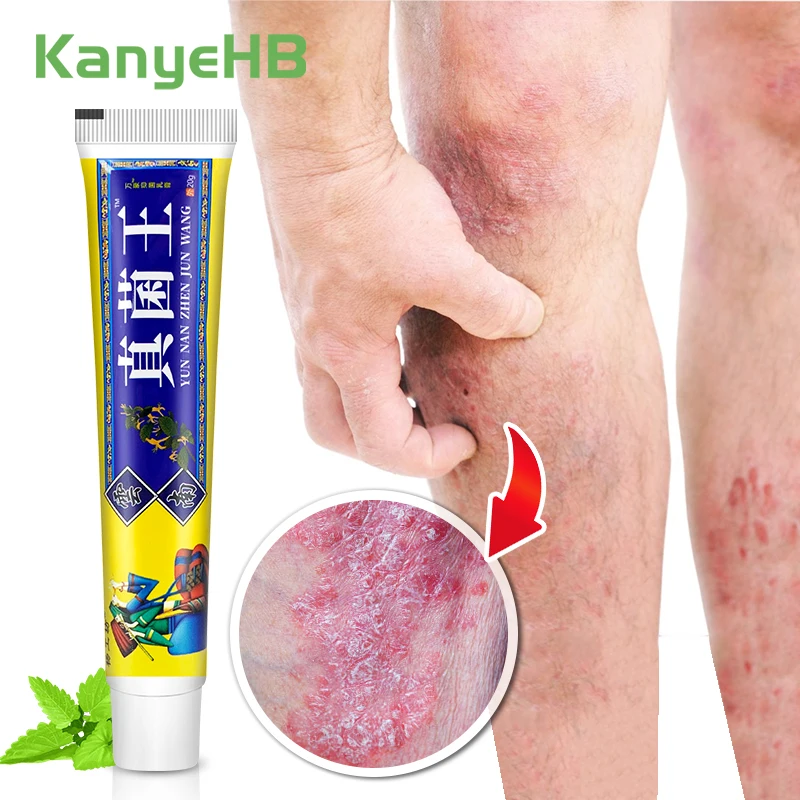 

1pcs Psoriasis Ointment Fungal Inhibition Cool Mint Cream Relieve Pruritus Treat Dermatitis Plaster Eczema Beriberi Cream S099