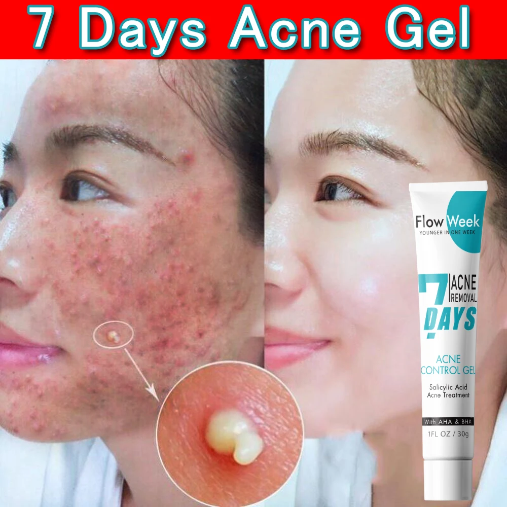 

Herbal Extract Acne Face Cream Herbal Pimple Scar Removal Shrink Pore Control Moisturizing Facial Cream Acne Treatment Skin Care