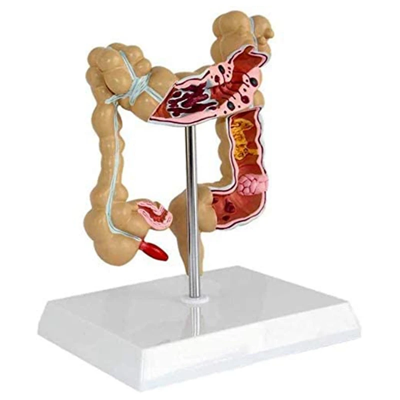 

Colon Pathological Colorectal Cancer Model Large Intestine Model Gastrointestinal Anatomical Model