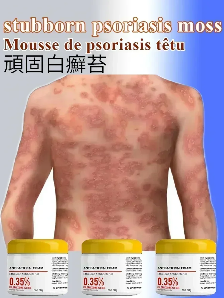 ГОРЯЧАЯ ПРОДАЖА Лечение мохообразного псориаза специальная мазь для лекарств