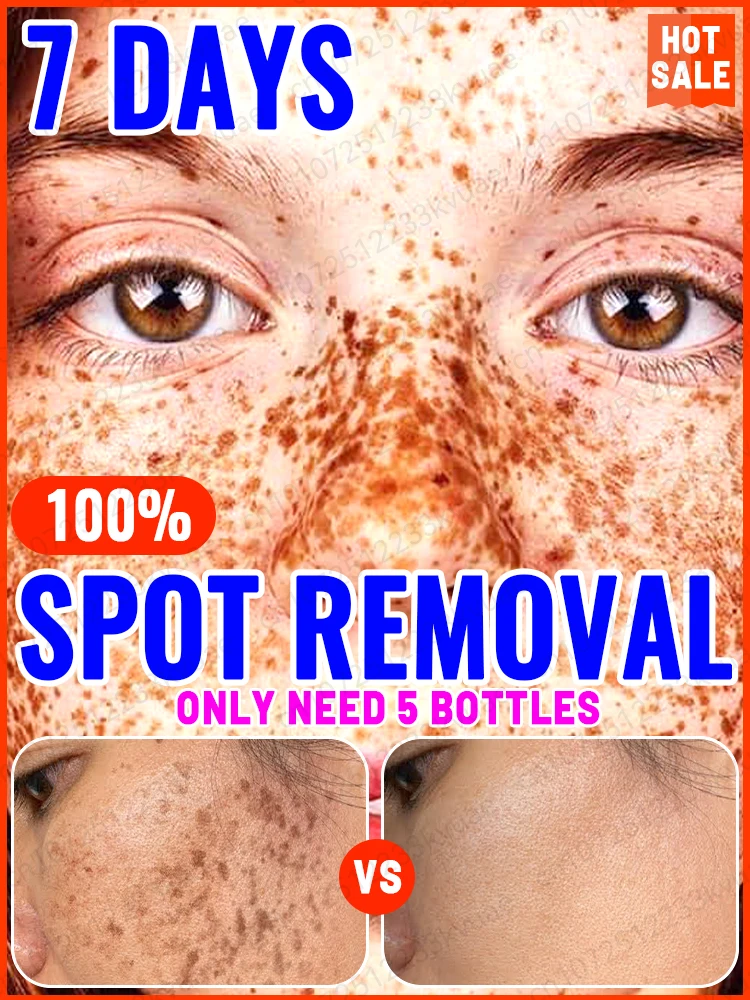 

Dark Spot Remover Melasma Chloasma Freckles Spot Removal Cream