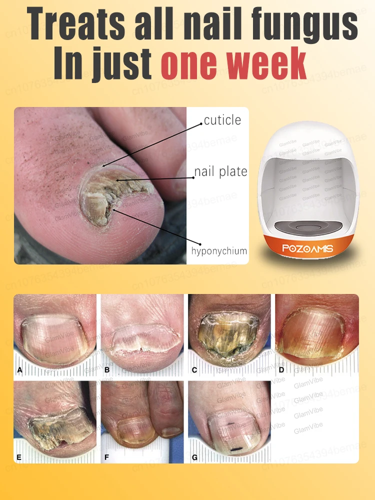 Деформированный терминал для ногтей Немезида кровотечения вросших