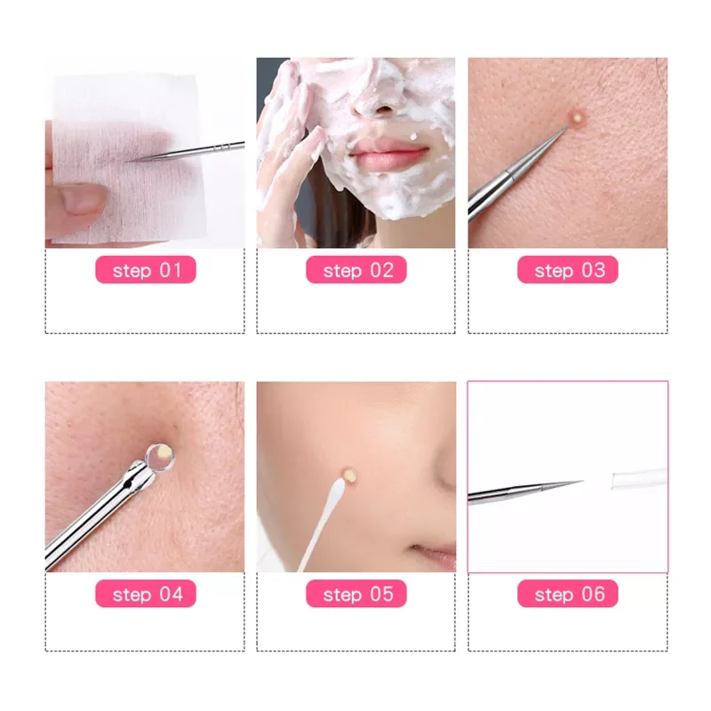 

NEW IN Pcs Blackhead Comedone Acne Pimple Blemish Extractor Remover Stainless Steel Needles Remove Tools Face Skin Care Pore Cle