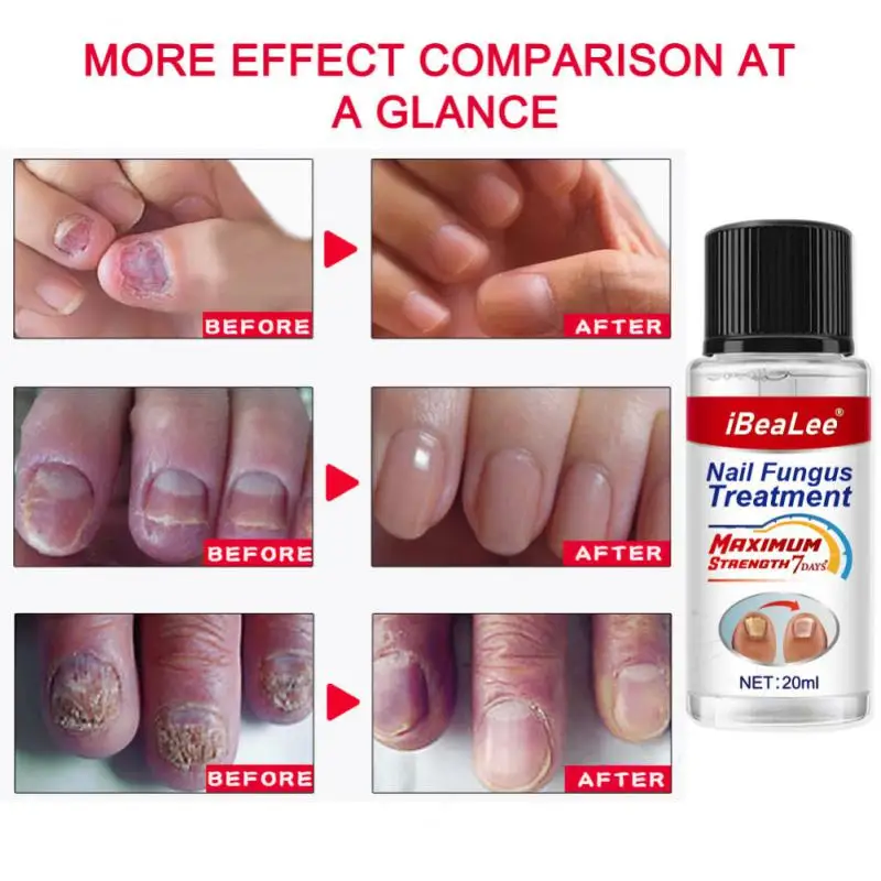 

20ml Fungal Nail Serum Care Repair Foot Nail Fungus Removal Gel Anti Paronychia Onychomycosis