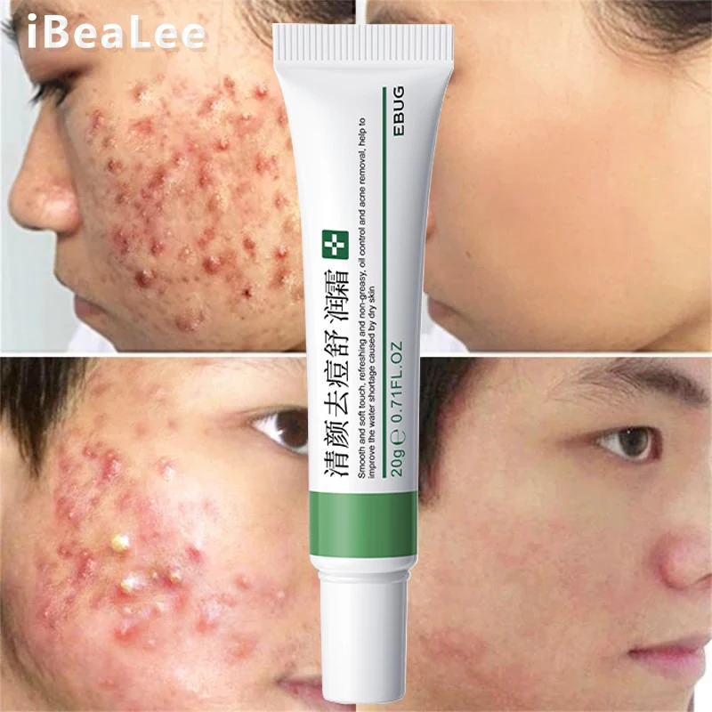 

iBeaLee Acne Removal Cream Herbal Acne Spots Oil Control Acne Cream Skin Care Whitening Moisturizing Face Gel Skin Care 20g