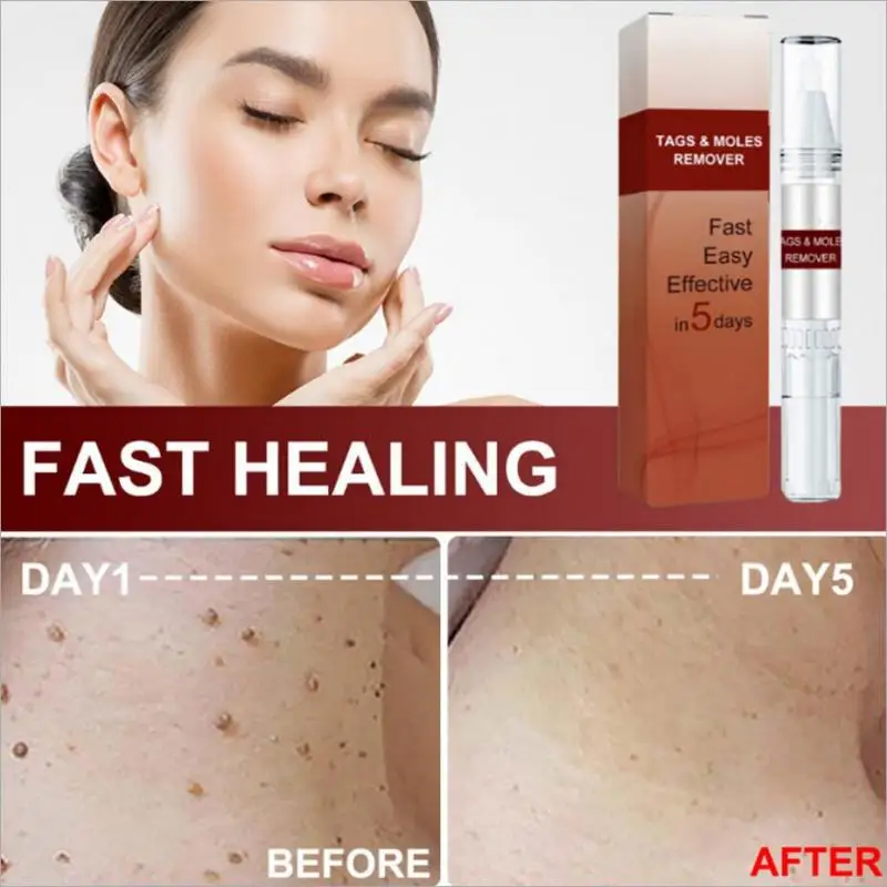 

Средство для удаления бородавок, 3 мл