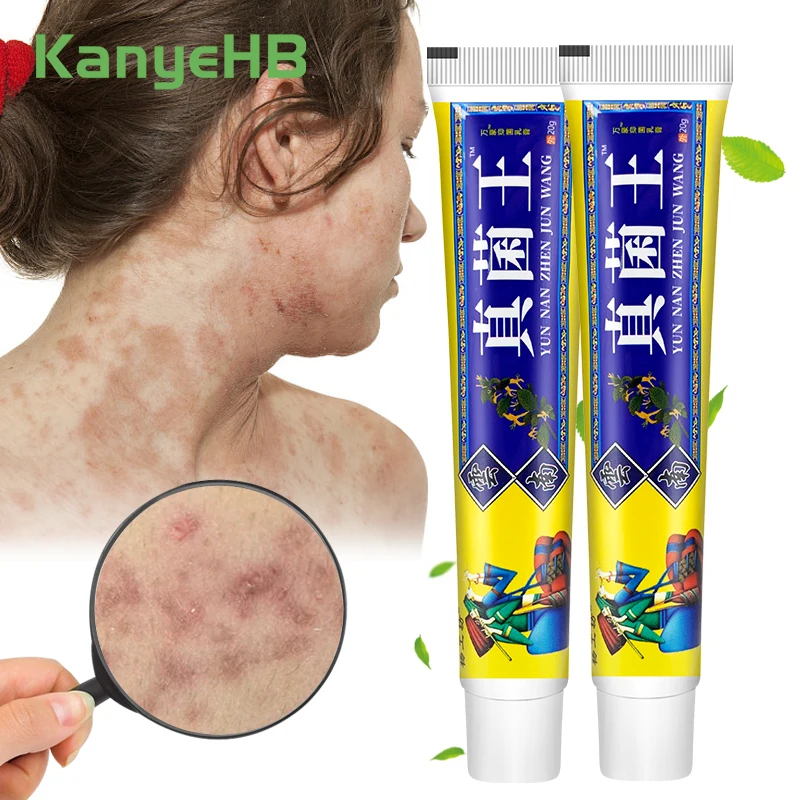 

Китайский медицинский крем от псориаз для лечения дерматита и экземы зуд, мазь для лечения грибковой ингибиции, A1543, 2 шт.