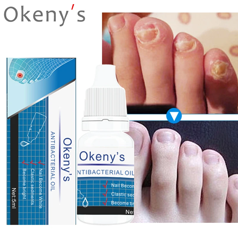 

Nail Fungus Treatment Serum Improve Onychomycosis Paronychia Oil Anti Infection Foot Repair Essence Remove Toe Cuticle Feet Care