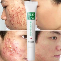 effective acne removal cream treatment herbal anti acne repair fade acne spots oil control whitening moisturizing face gel care