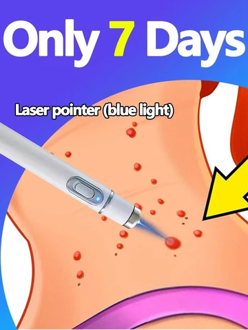 Лазерный аппарат для удаления бородавок