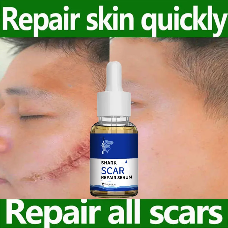 

Scar Removal Serum Acne Scars Remove Pregnant Stretch Marks Burn Surgical Scar Repair Essence Smoothing Whitening Skin Care 30ml