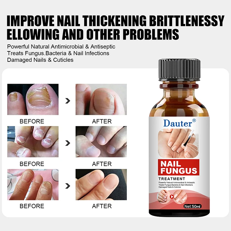 

10-50ml Nail repair Fungal Nail Treatment Serum Foot Repair Essence Care Whitening Toe Nail Fungus Removal Gel Anti Infection