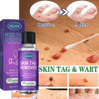 wart removal serum papillomas dark spot skin tag remover painless ointment antibacterial herbal extract beauty body care product