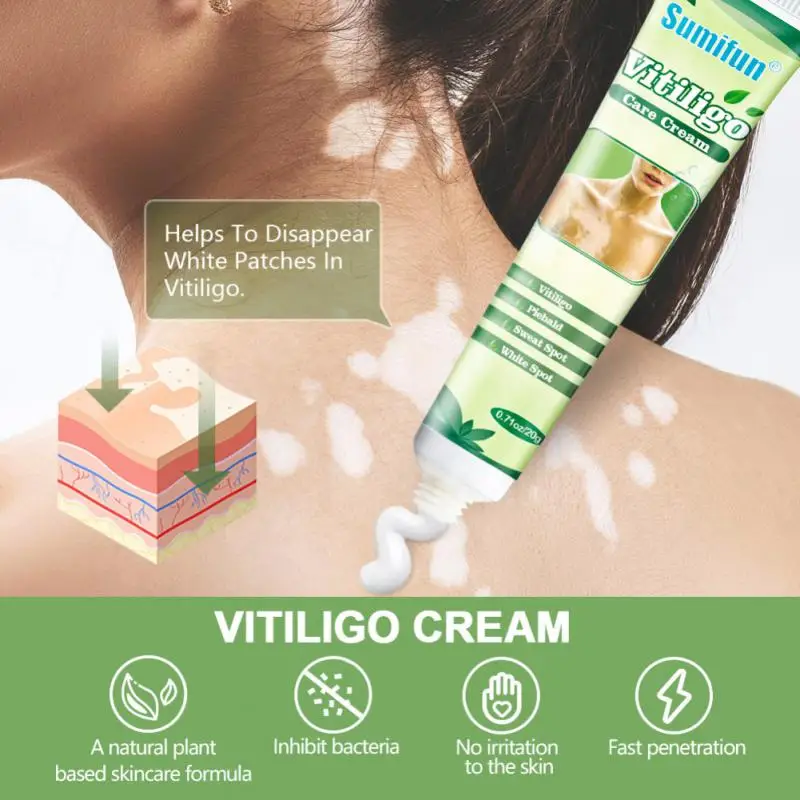 

Vitiligo Care White Spot Cream Bodys Treatments Skin External Health Repair Cream Chinese Medicine Health Accessories