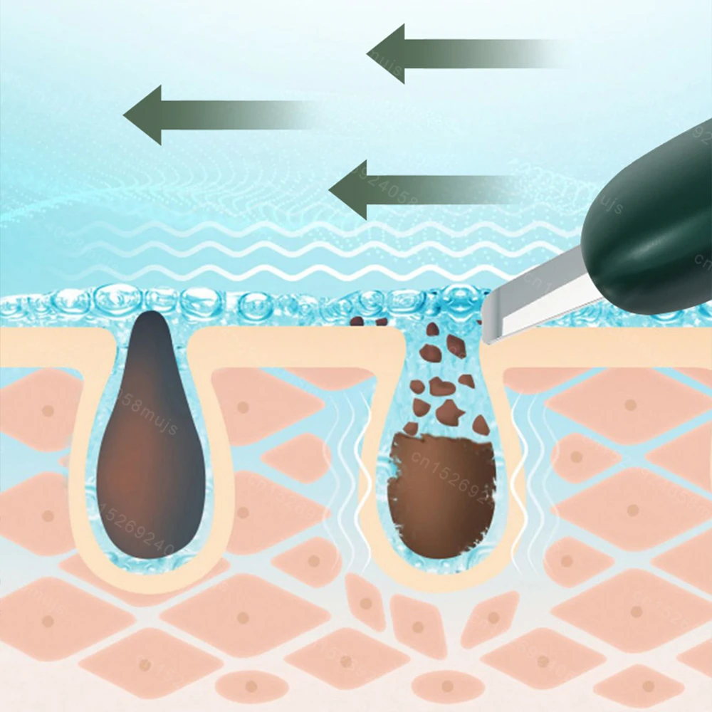 Средство для удаления черных точек средство очистки устройство сужения пор