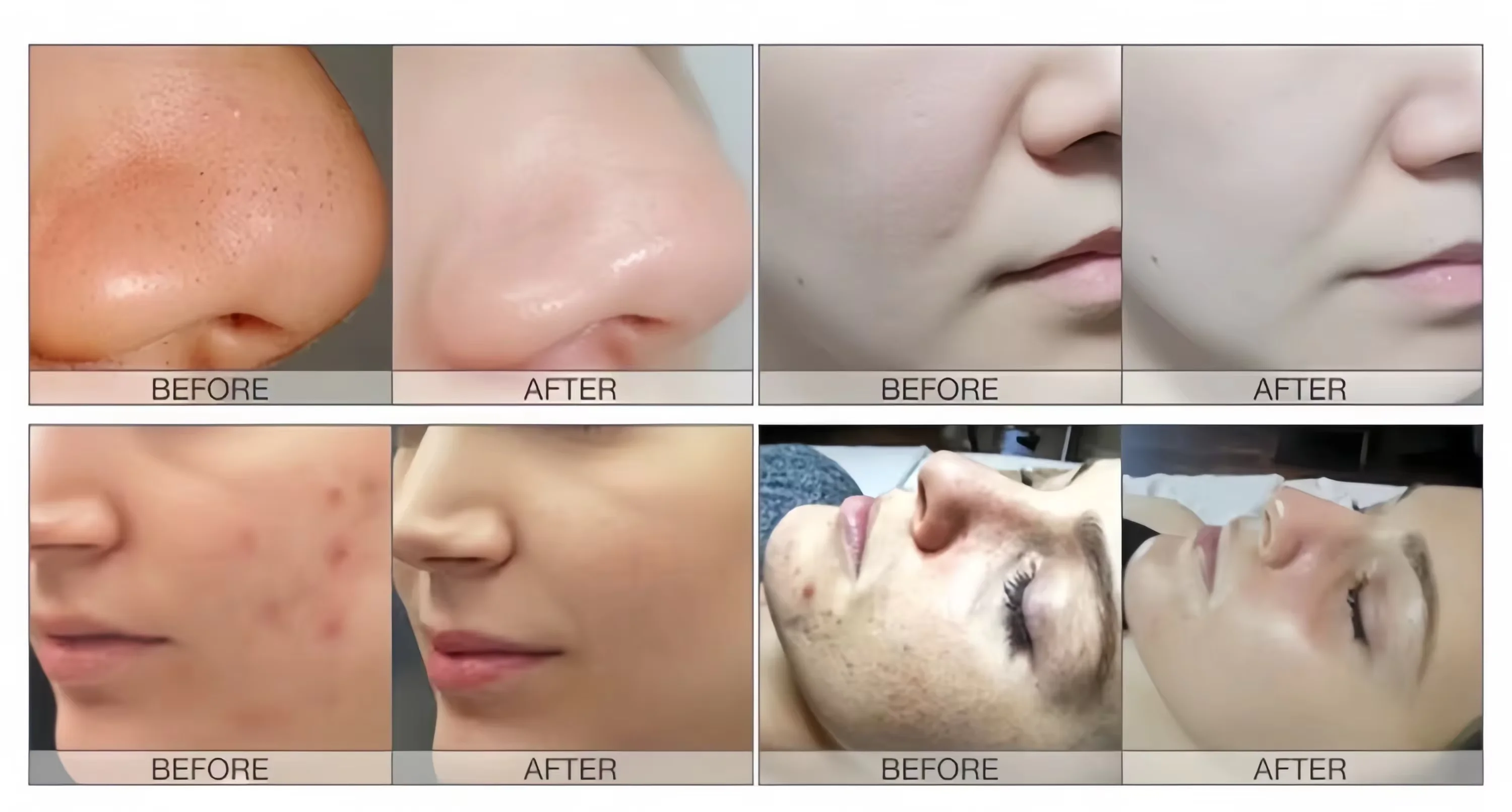 BCM кислородный супер пузырьковый отбеливающий косметический аппарат для