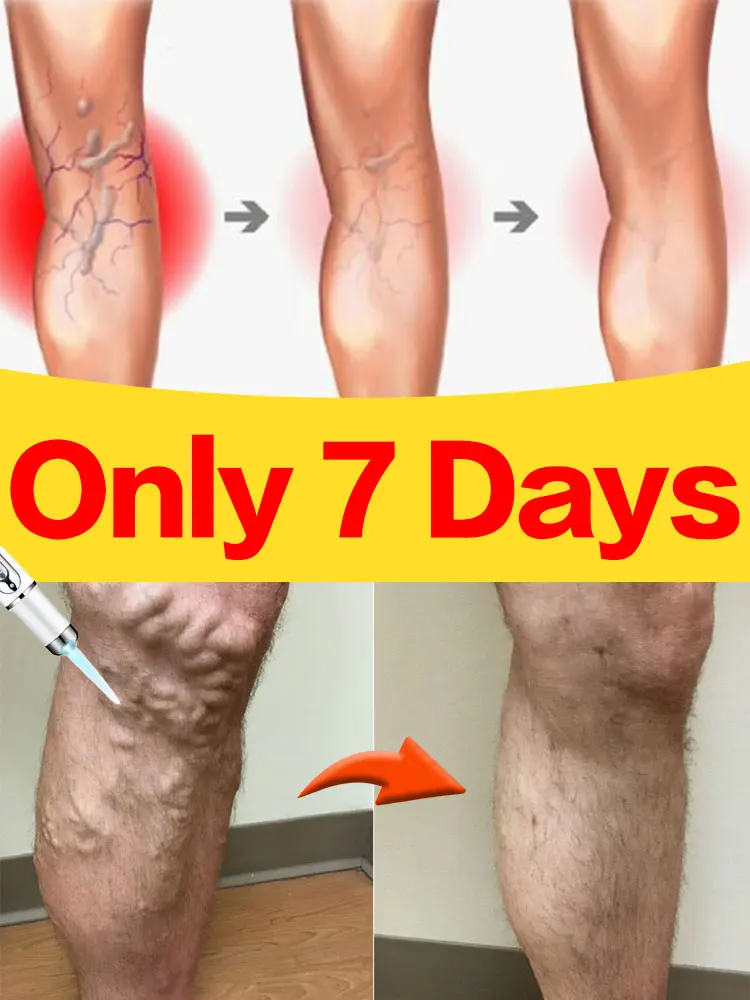 Крем-лазер Varicosse