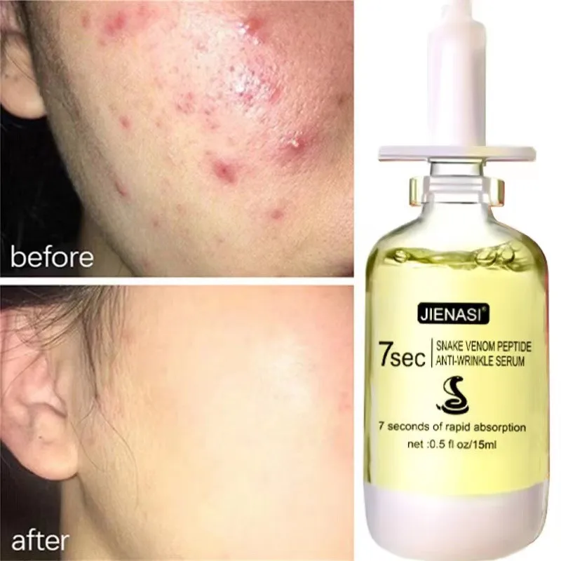 

Salicylic Acid Acne Removal Serum Effective Treatment Repair Spots Scar MoisturizingOil Control Shrink Pore SkinFace Care Beauty
