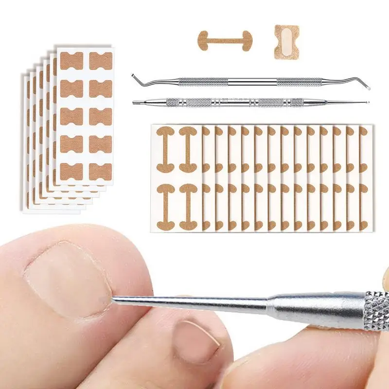 

Корректор для вросших ног, наклейки для коррекции вросших ног, выпрямитель, зажим, изогнутый бандаж для ног, инструмент для коррекции толщины ног