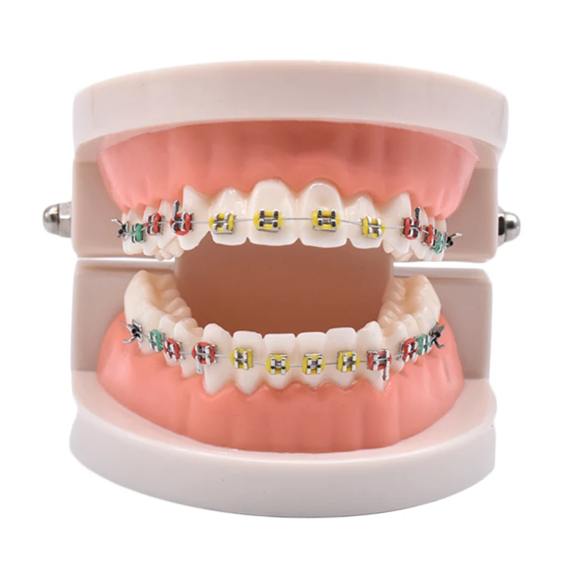 

Dental Orthodontic Treatment Model With Ortho Metal Ceramic Bracket Arch Wire Buccal Tube Ligature Ties Dental Tools Teeth Model