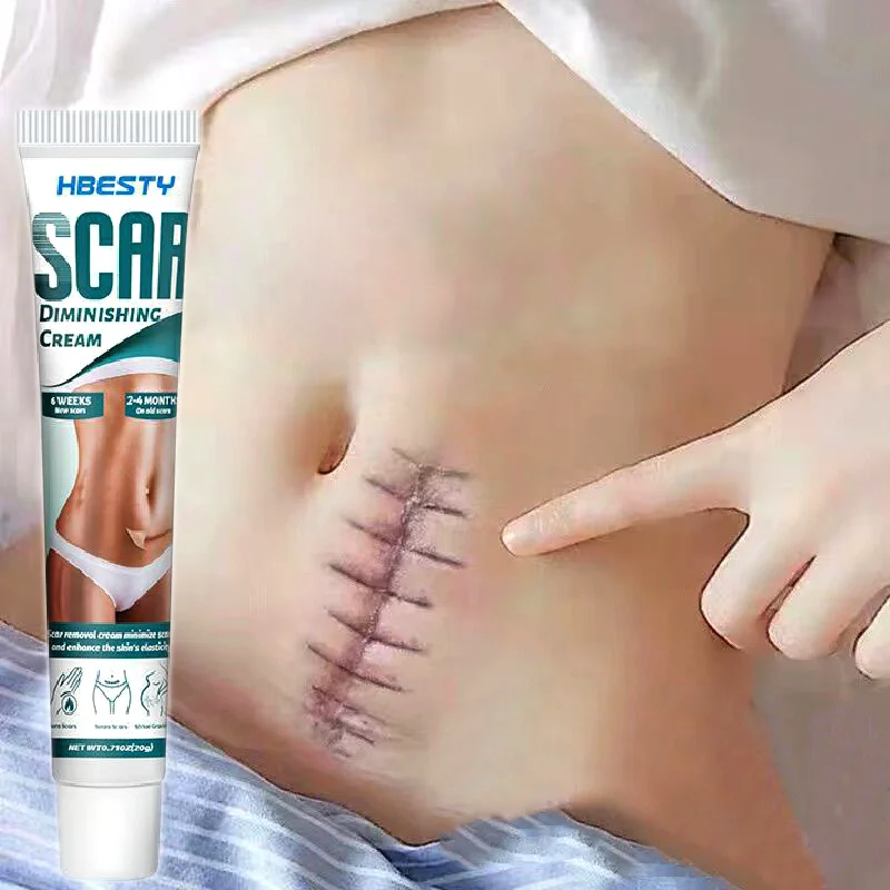 

Scar Removal Cream Fast Remove Scars Effectively Treat Skin Surgery Scars Stretch Marks Acne Pox Prints Burn Scars Facial Gel
